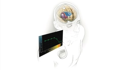 New Tinnitus Research Focused on Neural Networks Shows Promise for Precision Treatment