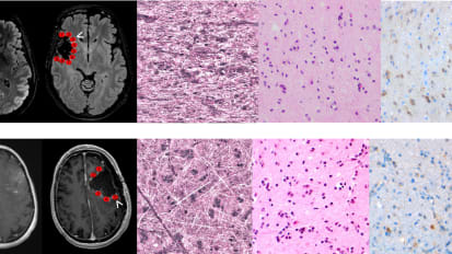 New Method for Rapid, Intraoperative Detection of Residual Tumor Cells Can Vastly Improve Patient Outcomes