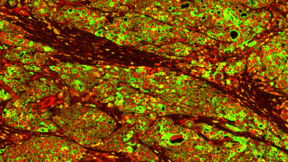 Ovarian cancer cells use stress hormone signaling to shut down immune system