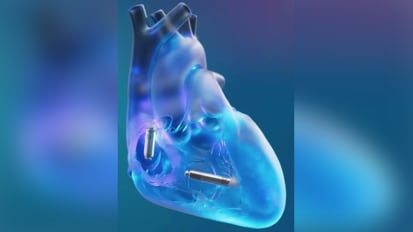 Leadless dual-chamber pacemaker is a leap forward for heart patients