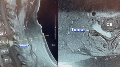 Challenging surgery removes dangerous, rare tumor from man’s spine
