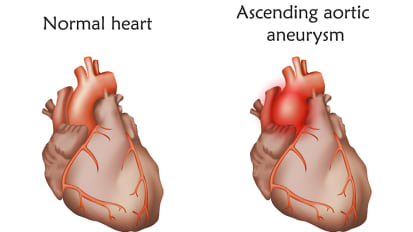 Aortic Aneurysm Risk: When Is the Right Time to Refer to a Specialist?