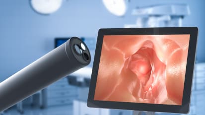 Endoscopic Removal of Benign Complex Colorectal Lesions Improves Patient Outcomes