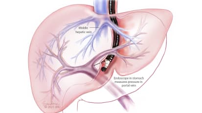 Endoscopic Ultrasound Measures Pressure in Hepatic Portal Vein