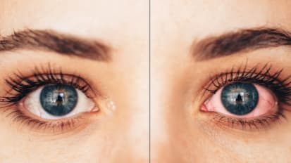 Understanding Uveitis: A Vision-threatening but Treatable Eye Disease