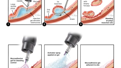 Gastroenterologist Develops Gel to Stop Bleeding After Precancerous Polyp Removal