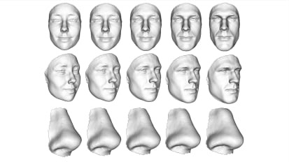 3D Facial Analysis Shows Biologic Basis for Gender-Affirming Surgery 