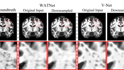 Enhancing MRI with AI to Improve Diagnosis of Brain Disorders