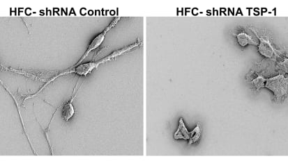 Scientists Discover a Deadly Brain Cancer’s Hidden Weakness