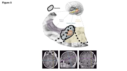 Seizures Stopped, Speech Preserved After Rare Auditory Cortex Tumor is Removed: A UCSF Case Study