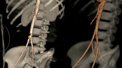 Aortic Endarterectomy for traumatic aortic dissection