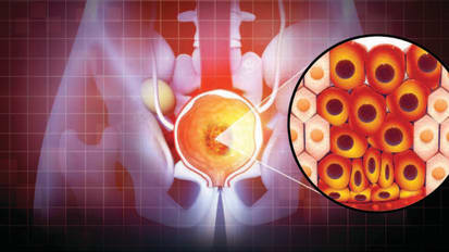 BENIGN PROSTATE HYPERPLASIA