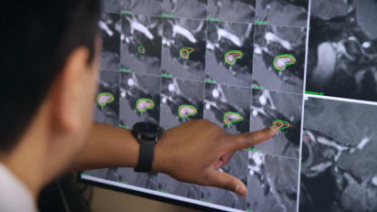 Gamma Knife gives brain cancer patients access to top team and technology