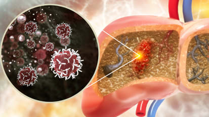 Johns Hopkins Hepatologists Detect Liver Cancer in Urine Test