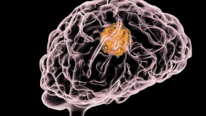 Novel Biomarker-Guided Therapeutics Target Glioma Origins