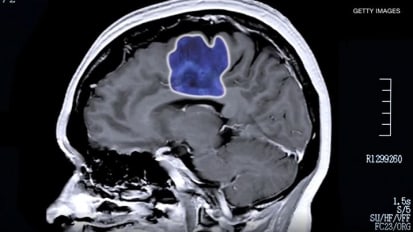 Glowing Tumors: How Fluorescence Helps Neurosurgeons Fight Brain Cancer