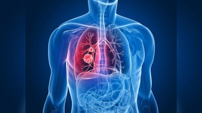 FDA Approves Drug to Treat Non-small Cell Lung Cancer