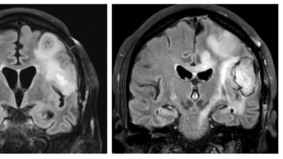 Pressing pause on low-grade gliomas: The long road to a breakthrough treatment