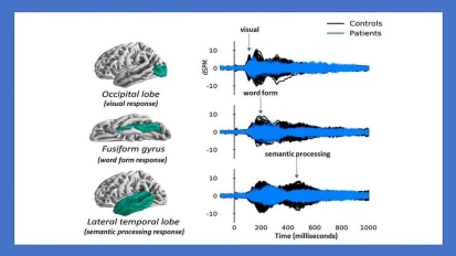 Minor Strokes Lead to Global Disruptions in Brain Signaling and Cognitive Dysfunction