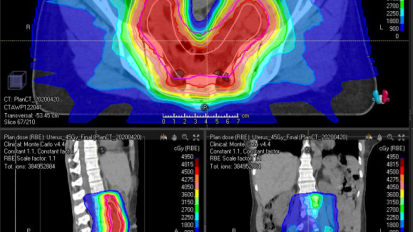 Proton Therapy Case Studies – Gynecologic Cancers
