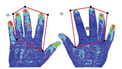 Easing Raynaud’s in Scleroderma Patients