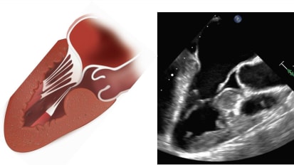 A Multidisciplinary Approach to Hypertrophic Cardiomyopathy: The Right Treatment for Each Patient