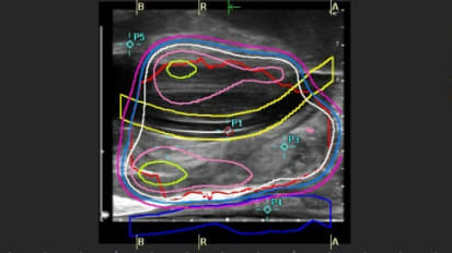 New Advanced Multidisciplinary Prostate Cancer Treatments Provide Individualized Care