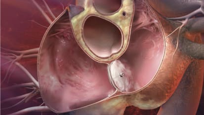 Healing a Hole in the Heart