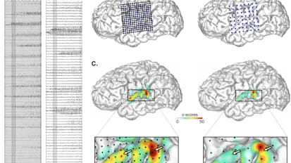 Lo-Res to Hi-Res, A Better way to Pinpoint Where Seizures Begin