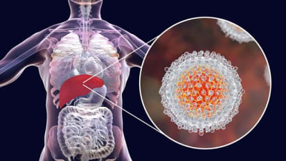 No Downside But Cost to Hep C Antivirals, Hepatologist Says