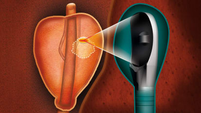 Focal High-Intensity Focused Ultrasound Ablation for Intermediate-Risk Prostate Cancer