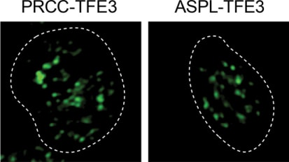 Study uncovers how biomolecular condensates cause some kidney cancers