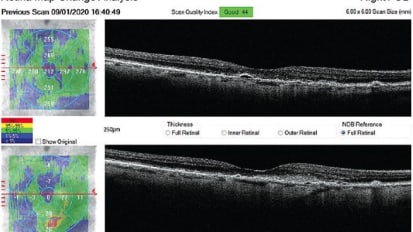 How to Care for the Dry AMD Patient