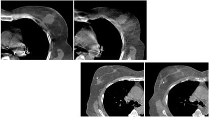 Enhancing Breast Patients’ Experience Through Adaptive IMRT Study