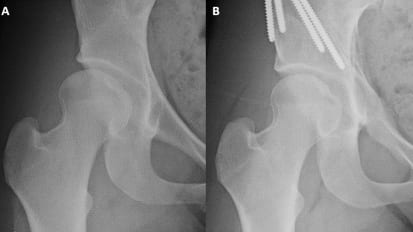 Joint Preservation Surgery Shows Promise in Young Adults with Hip Dysplasia