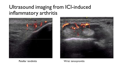 Cancer Patients Blindsided by Treatment-Induced Inflammatory Arthritis