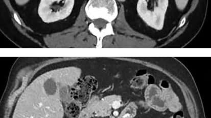 Combination Immunotherapy Combats AR-V7+ Prostate Cancer