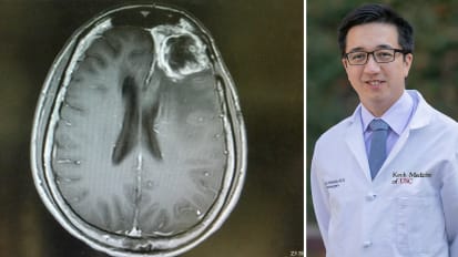 Identifying Novel Genetic Targets in Glioblastoma Using <em>in vivo</em> CRISPR Screening