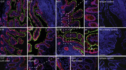 Registry Tracks How IBD Drugs Interact With COVID-19