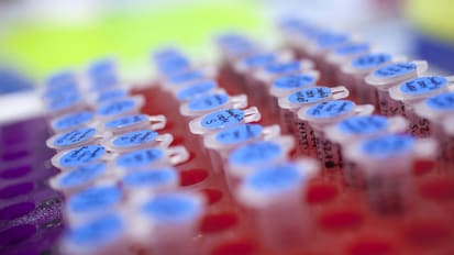 Mount Sinai-Led Research Team Identifies Underlying Mechanisms of Age-Related Dysfunction in Glands Crucial to Eye Function