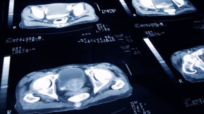 Prostate Cancer Care: Advances in Risk Stratification, Imaging and Treatment