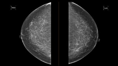 Beyond Detection: How AI Is Reshaping Breast Imaging and Risk-Based Screening