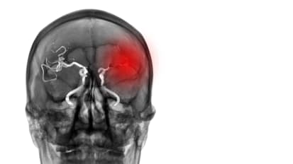 Clinical Trial Leading to Better Brain Oxygenation for Acute Ischemic Stroke Patients