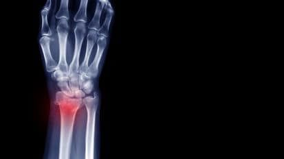 Rethinking Distal Radius Fractures: Evolving Strategies for the Active Osteoporotic Patient