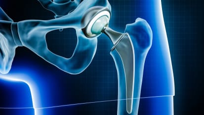 High Rates of Return to Soccer After Primary Hip Arthroscopic Labral Repair for Femoracetabula Impingement Syndrome