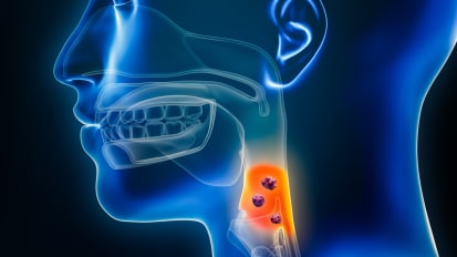 For Your Patients: The Latest Advances in Head and Neck Cancer Treatment