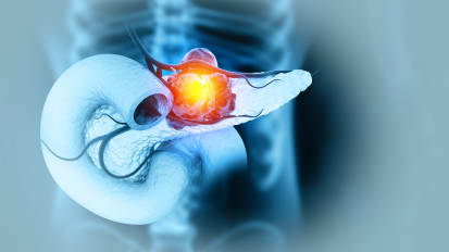 Advancing the Treatment Paradigm for Pancreatic Cancer