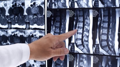 Why Some Disk Problems Don’t Improve With Standard Treatment