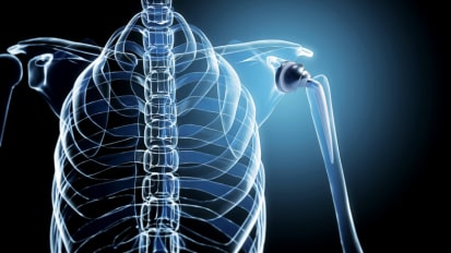 Advanced Shoulder Replacement for Orthopedic Referrals Natural-motion design. Bone-preserving technique. Advanced care for patients limited by shoulder pain.
