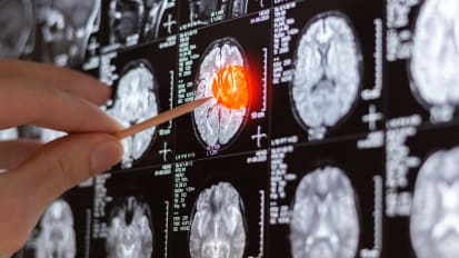 Radiation Therapy Research: Miami Cancer Institute Publishes Multiple High-Impact Studies